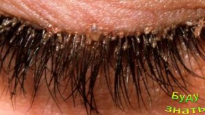 Клещи поселились на ее Ресницах! Как так получилось?