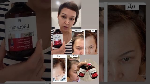 Шампунь для роста волос #алопеция #волосы #ростволос #шампуньдляволос