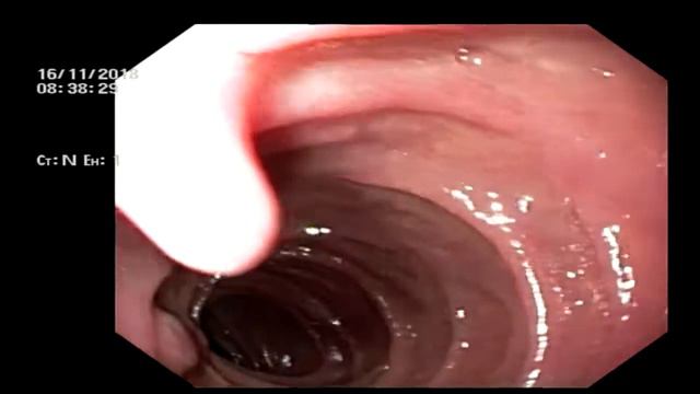 ФГДС смотреть онлайн