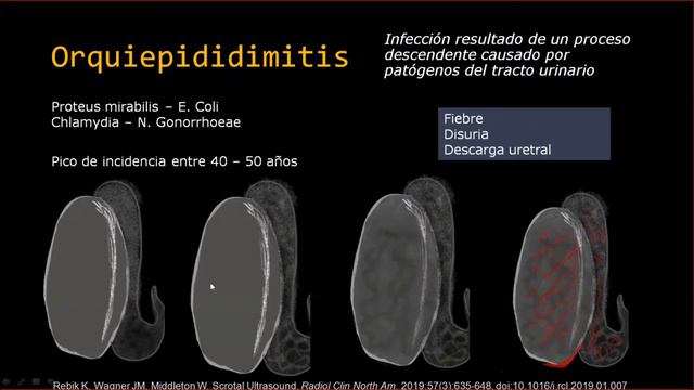 Caso Clínico 18: Dolor Testicular Agudo. смотреть онлайн