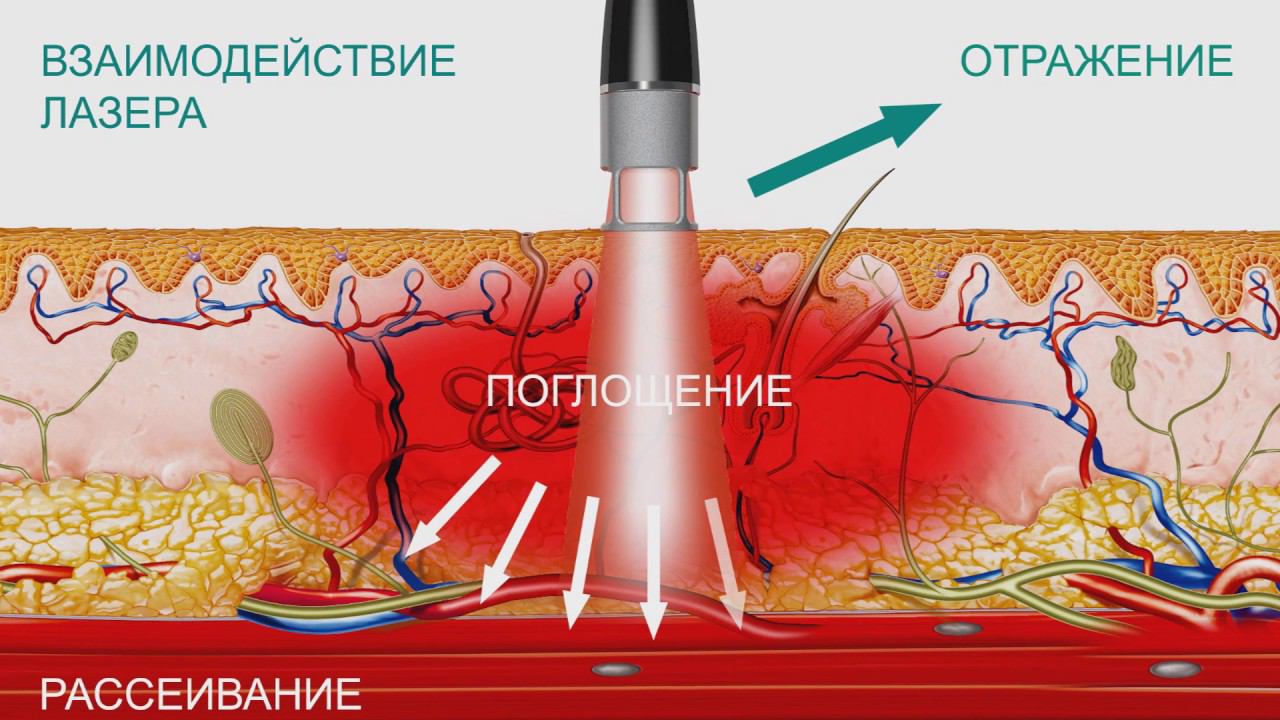Лазер высокой интенсивности BTL-6000 HIL. Особенности технологии и медицинские эффекты. смотреть онлайн