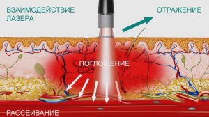 Лазер высокой интенсивности BTL-6000 HIL. Особенности технологии и медицинские эффекты.