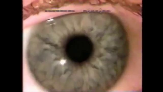 7 Types of nystagmus смотреть онлайн