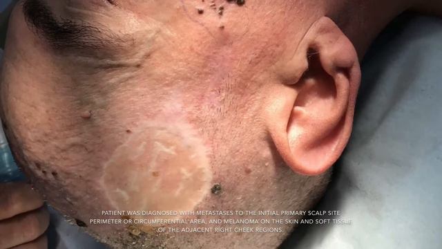 Surgical Oncology   Head & Neck Region Malignant Melanoma Recurrence  56 Year Old Caucasian Male Pa