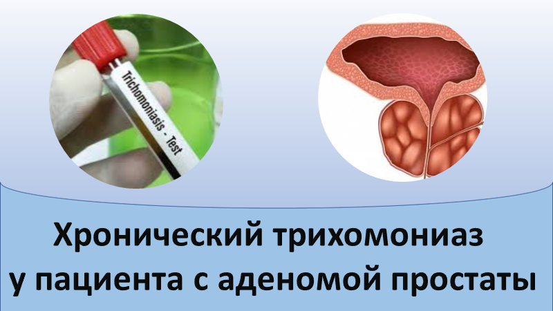 Хронический трихомониаз у пациента с аденомой простаты смотреть онлайн