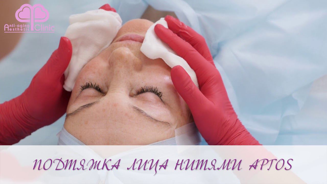 Нити Аптос Визаж. Установка нитей Аптос смотреть онлайн