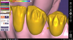 Моделирование циркониевых коронок на имплантатах