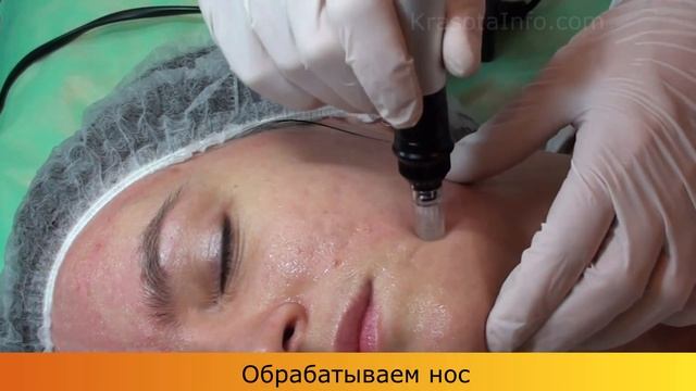 Дермаштамп профессионалам смотреть онлайн