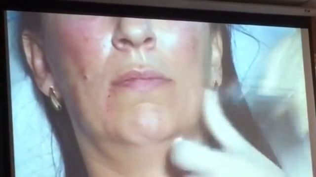 5 болюсов для коррекции морщин марионеток. Estet-portal.com