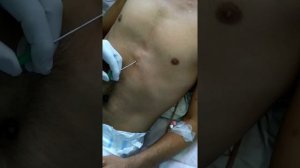 Ещё одна пункция перикарда