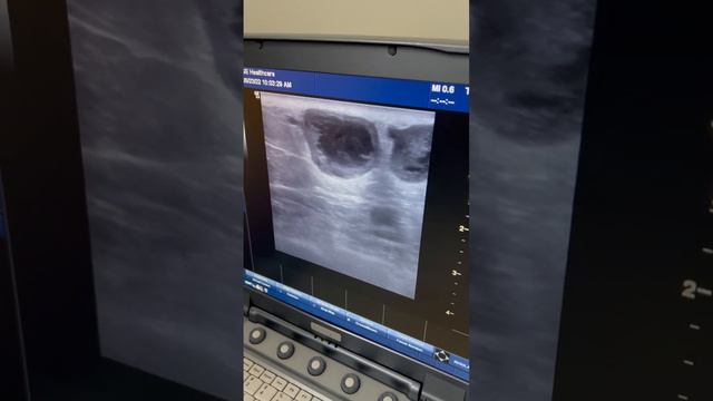 Проведение УЗИ у пациента с тромботическими осложнениями нижних конечностей. смотреть онлайн
