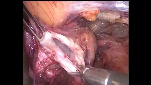 Laparoscopic (TAPP) inguinal hernia repair Лапароскопическая герниопластика ТАРР - 12 смотреть онлайн