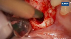 Открытый синус лифтинг и установка имплантата Bone Trust Sinus