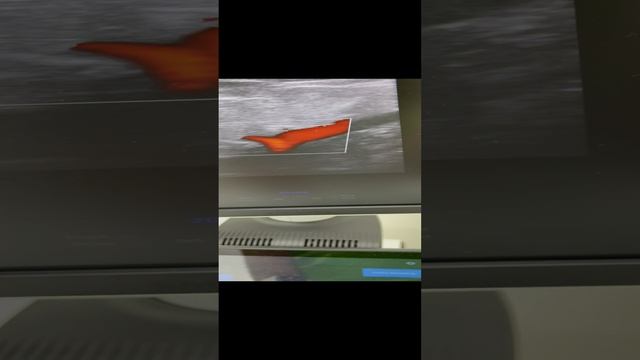 Инфекция мягких тканей. Рожистое воспаление. Повышенный вес, 140 кг. Идеальные вены. Флеболог Москва смотреть онлайн