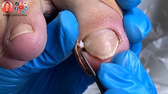 Почему не держится титановая нить? / Установка коррекционной системы смотреть онлайн