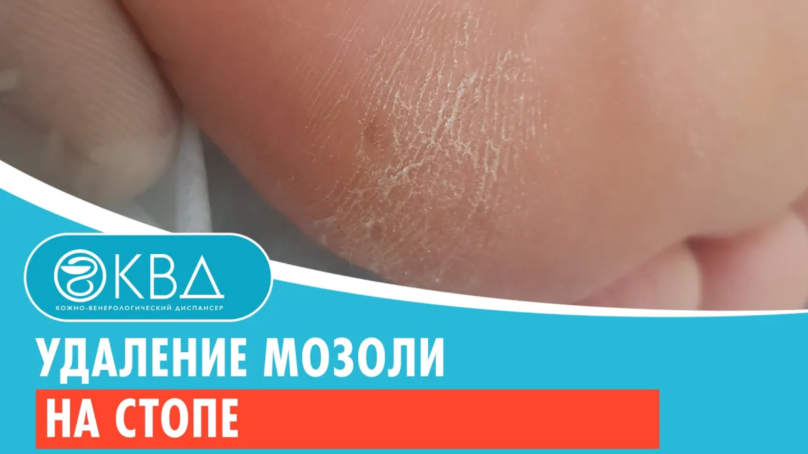 ✅ Удаление мозоли на стопе. Клинический случай №929 смотреть онлайн