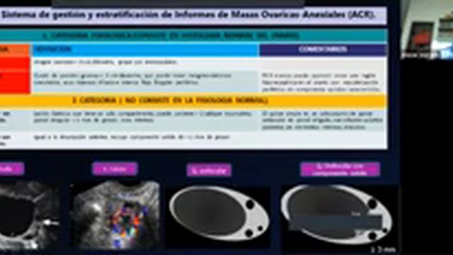 Charlas 26 de agosto Coriocarcinoma y O RADS смотреть онлайн