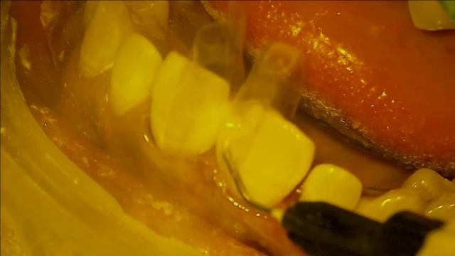 Diastema Closure using Bioclear Matrix смотреть онлайн