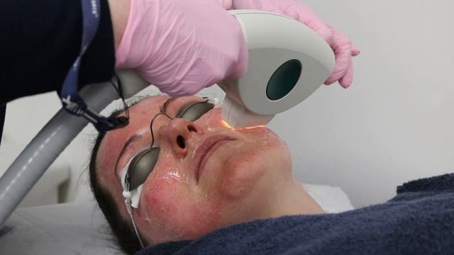 IPL Skin Rejuvenation смотреть онлайн