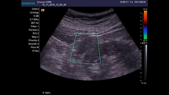 Рак почки смотреть онлайн