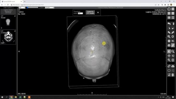 How to export DICOM to STL model with jsInvols