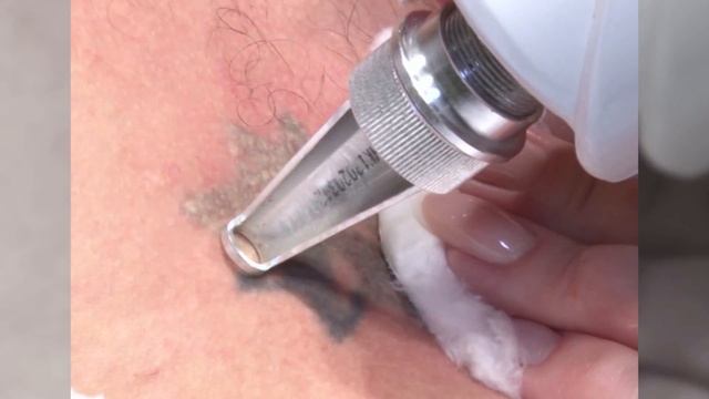 2. Удаление татуировок смотреть онлайн