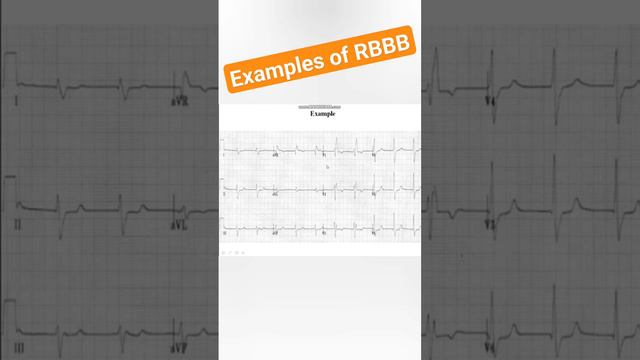 Examples of RBBB #ecg смотреть онлайн
