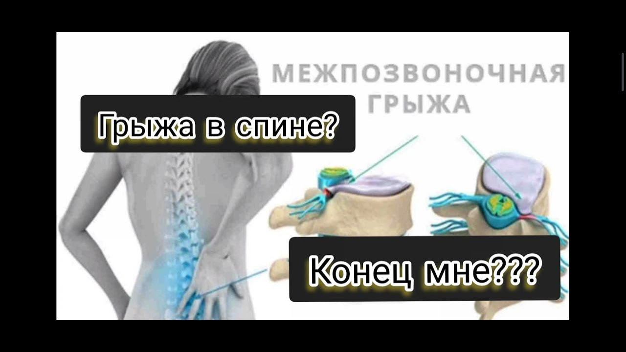 Грыжа в спине! Лечение или развод на деньги? Личный опыт физического реабилитолога Винявского В.В смотреть онлайн