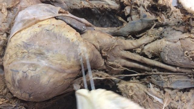 Pericardium And Transverse Sinus And Oblique Sinus