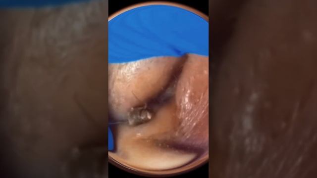 Акне. Черные точки. Вросшие волосы и прыщи. Ушная пробка и сера! смотреть онлайн