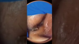 Акне. Черные точки. Вросшие волосы и прыщи. Ушная пробка и сера!