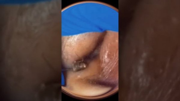 Акне. Черные точки. Вросшие волосы и прыщи. Ушная пробка и сера!