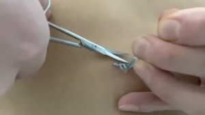 Как снять швы в домашних условиях !!!