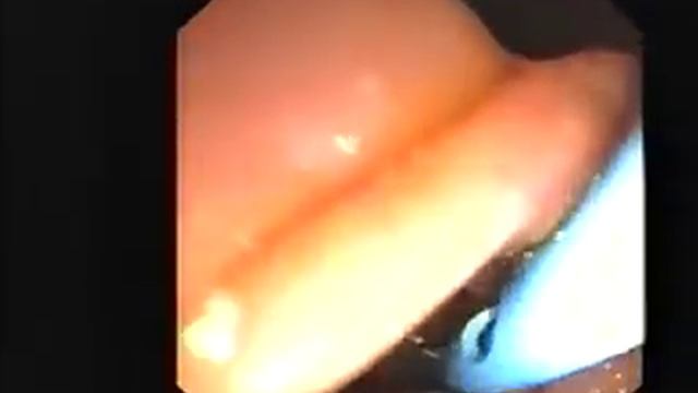 Endoscopy Master Videos: ERCP Billroth II video @ www.gastroliver.com.sg смотреть онлайн