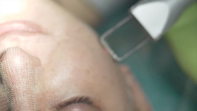 Лазерная фракционная СO2 шлифовка лица смотреть онлайн