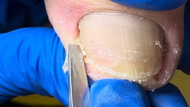 Pedicure Tutorial: Ingrown Nail Repair, Pain Relief!【Xue Yidao Pedicure】