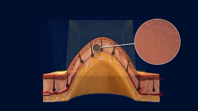 LightSheer® DUET – диодный лазер с технологией вакуумного усиления смотреть онлайн