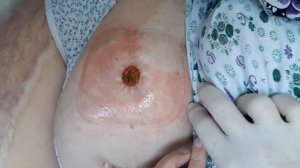 Уход за колостомой. (сформировавшейся, опер. несколько лет назад)