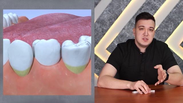 Пришеечный кариес: виды, лечение, профилактика смотреть онлайн