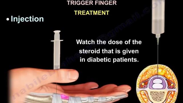 Trigger Finger & Trigger Thumb - Everything You Need To Know - Dr. Nabil Ebraheim смотреть онлайн