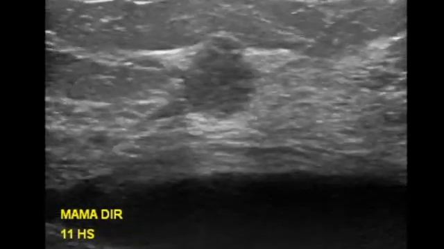 BI-RADS 6 BREAST NODULE AT ULTRASOUND | BIOPSY PROVEN BREAST CANCER смотреть онлайн