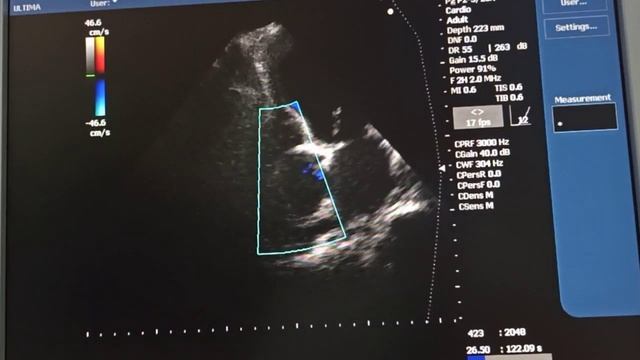 Диссинхрония сокращения миокарда при блокаде левой ножки пучка Гиса смотреть онлайн