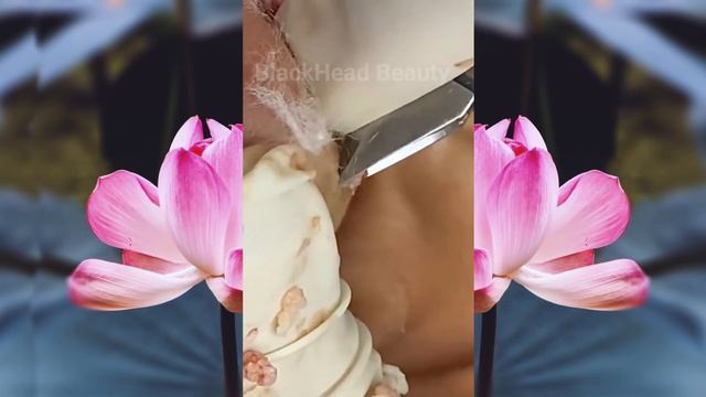 Выдавливание чёрных точек НОВОЕ! Удаление чёрных точек за ухом. p17 смотреть онлайн