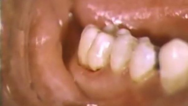 Adhesive Dentistry Using Glass Ionomers