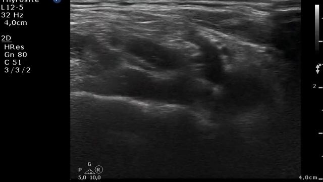 Metastasis of a papillary thyroid cancer Lymph nodes in the neck case 9 смотреть онлайн