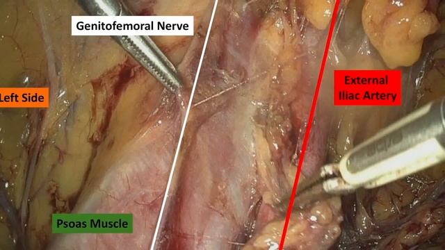 Laparoscopic sentinel lymph node mapping and lymphadenectomy by Dr. Marcello Ceccaroni, MD., Ph.D. смотреть онлайн