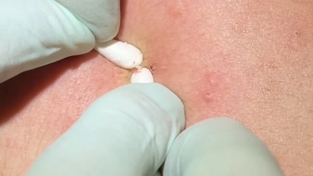 Tons Of Blackheads On The Back. Acne Extractions. Blackheads And Whiteheads. Mining Pore Dirt.