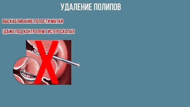 Полипы эндометрия и цервикального канала смотреть онлайн