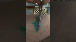 Снятие швов в домашних условиях