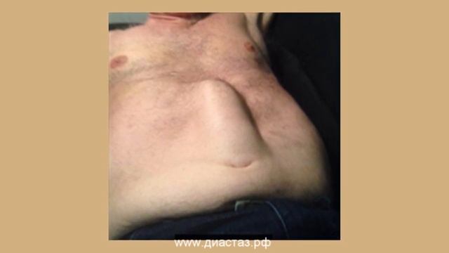как выглядит диастаз прямых мышц живота